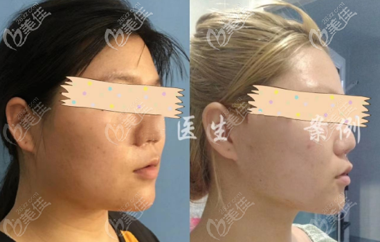 重庆军美面下部吸脂案例