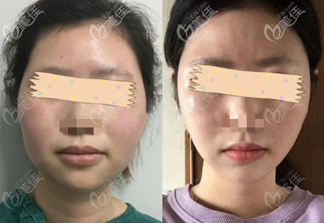 重庆军美面部双下巴吸脂术后半年对比效果图