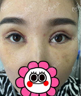 内眼角开大了修复后的第5天的图片