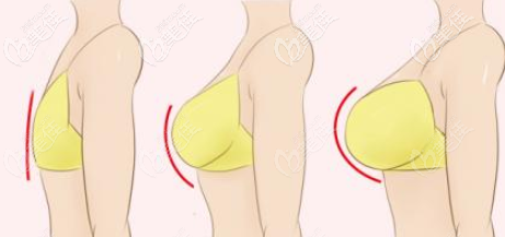 自体脂肪丰胸