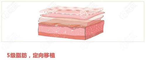 5级脂肪定向移植