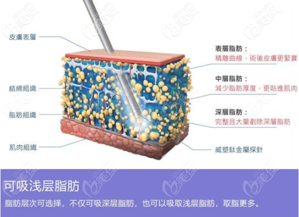 各个不同层次分区取脂
