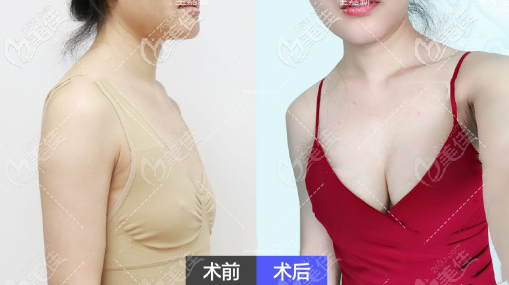 点对点自体脂肪丰胸效果图