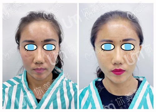 微提id小胶片面部提升案例