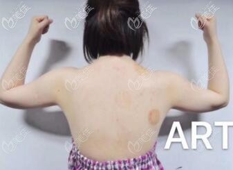 吸脂瘦手臂前 吸脂瘦手臂前