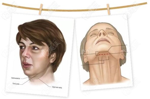 颈阔肌提升的下巴切口位置 颈阔肌提升的下巴切口位置