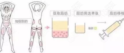 自体脂肪移植填充过程