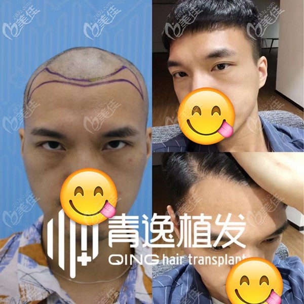男士M型发际线种植