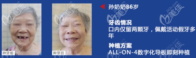 在做过全口即刻种植牙的叔叔阿姨们都怎么样了？