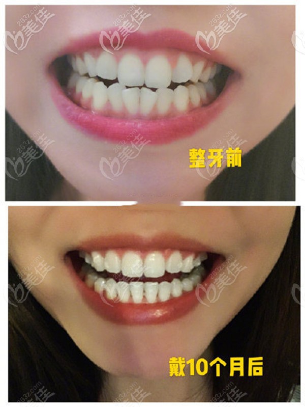 淮安牙知道口腔隐形矫正效果
