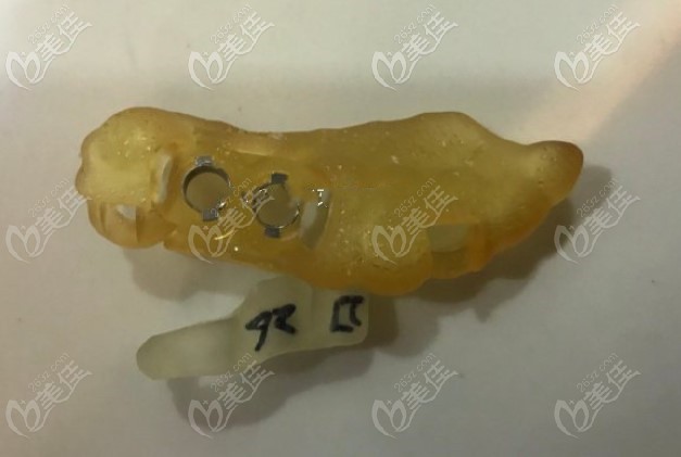 雅悦齿科种牙时使用的种植导板