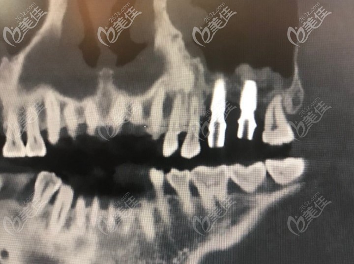 做了两颗牙齿后拍的CT