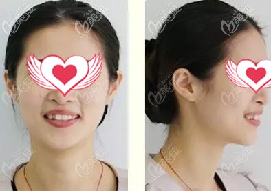 南山麦芽口腔时代天使正畸案例 南山麦芽口腔时代天使正畸案例