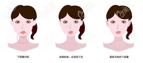 下颌缘提升的必要性 下颌缘提升的必要性