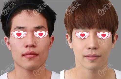 韩国原辰面部综合整形真人前后对比照 韩国原辰面部综合整形真人前后对比照