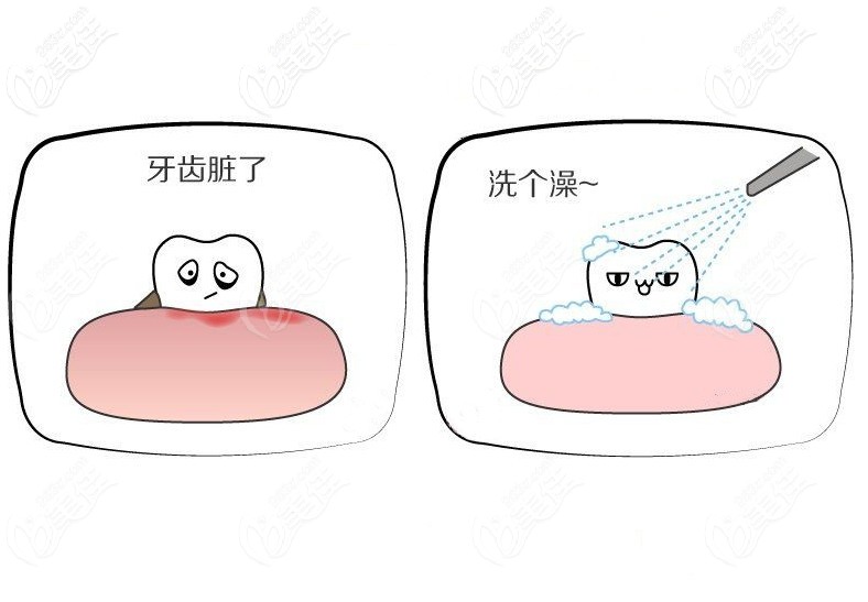 牙齿脏了就来做个超声波洗牙