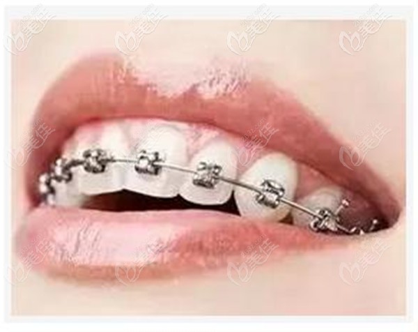 金属自锁托槽矫正牙齿比较方便安全
