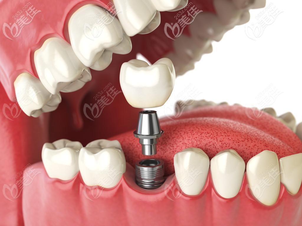 牙齿缺失就做伤口小和恢复的种植牙