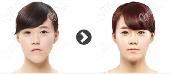 歪脸地包天在韩国ID整形医院做双鄂手术的案例