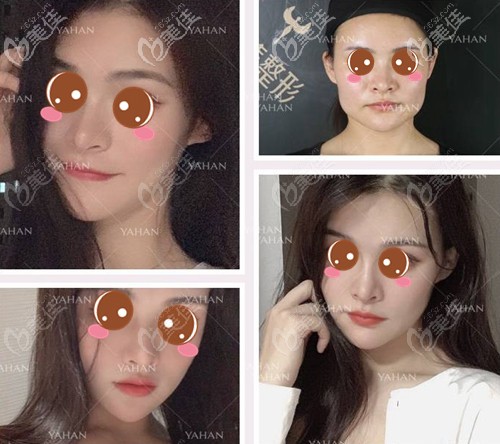 赵贵庆颧骨内推+长曲线下颌角案例