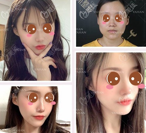 赵贵庆长曲线下颌角手术案例