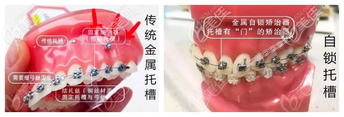 传统金属牙套和金属自锁在效果上没有多大的区别,自锁牙套,是传统牙套