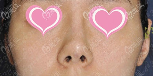 隆鼻后鼻头挛缩