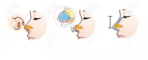 鼻头挛缩修复手术过程