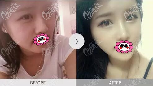 面部综合整形真人对比案例照 面部综合整形真人对比案例照