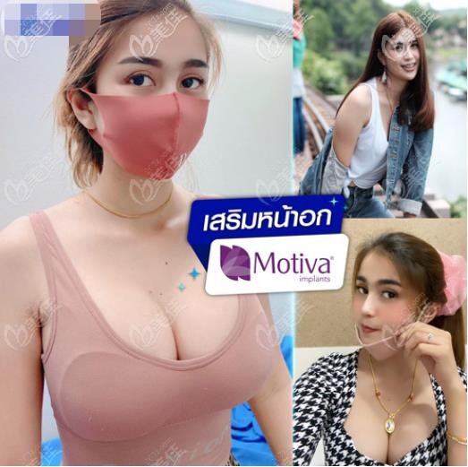 真实案例分享：泰国隆胸假体500cc效果图