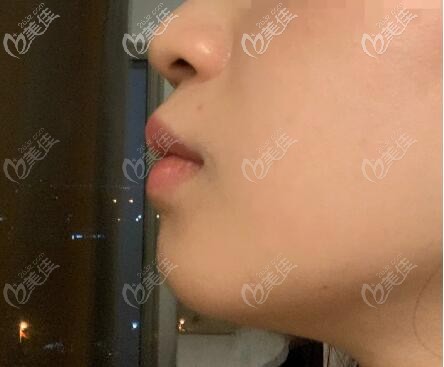 做下巴截骨前移手术前照片