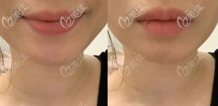 亲历者下巴截骨前移手术前后效果对比图