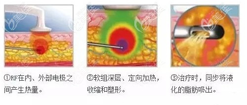 黄金微雕溶脂过程