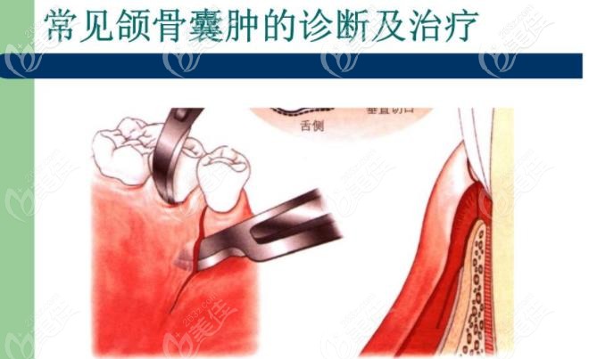 颌骨囊肿的诊疗示意图