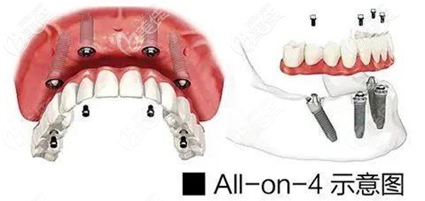 ALL- on-4种植牙技术