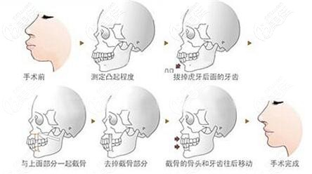 正颌手术过程示意图 正颌手术过程示意图