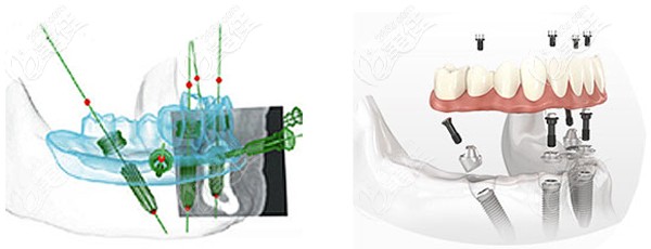 all-on-4种植牙技术优势