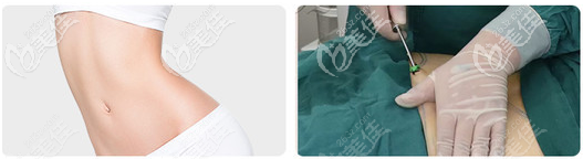 深圳艺星吸脂技术优势 深圳艺星吸脂技术优势