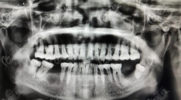 父亲满口牙松动牙片