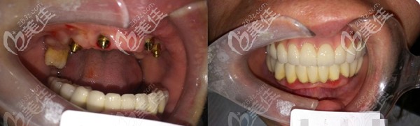 60岁父亲满口牙松动做all-on-4全口种植牙后表示：后悔知道晚了