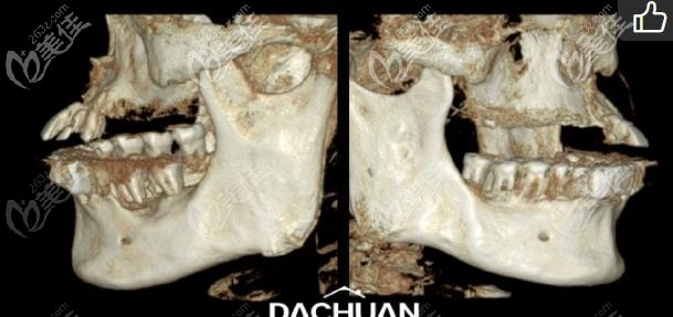 做种植前的牙齿情况 做种植前的牙齿情况