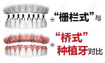 传统的种牙方式和桥式中牙对比