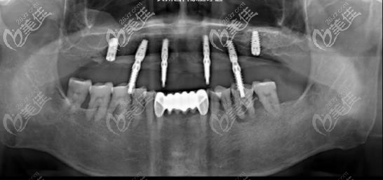 种植牙手术方案