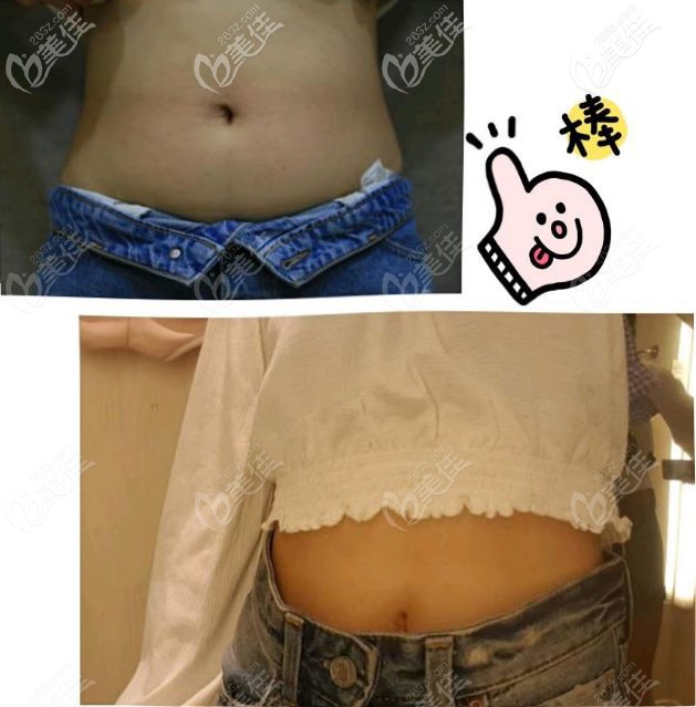 <!--<i data=20240703-sp></i>-->腰腹吸脂真人案例 <!--<i data=20240703-sp></i>-->腰腹吸脂真人案例