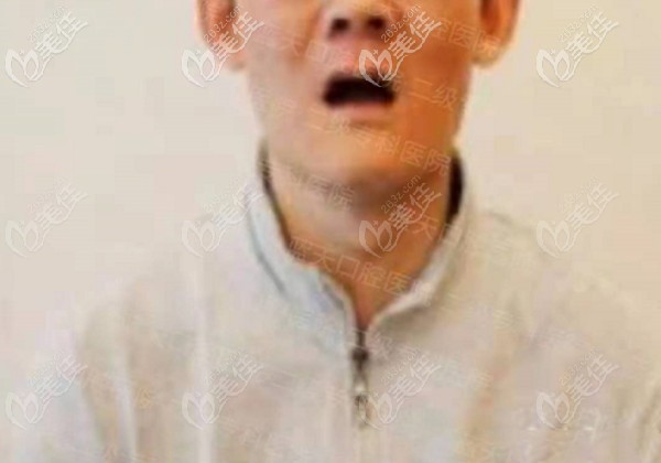 全口种植牙前的照片