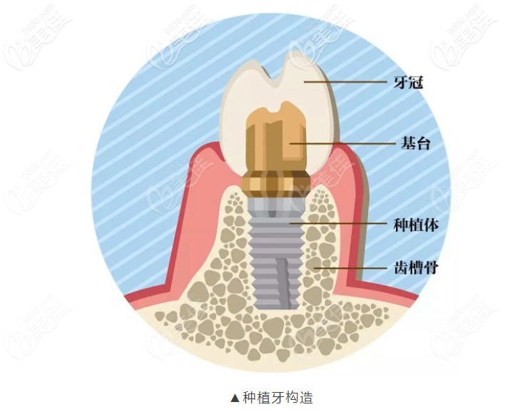 这个是种植牙的结构图