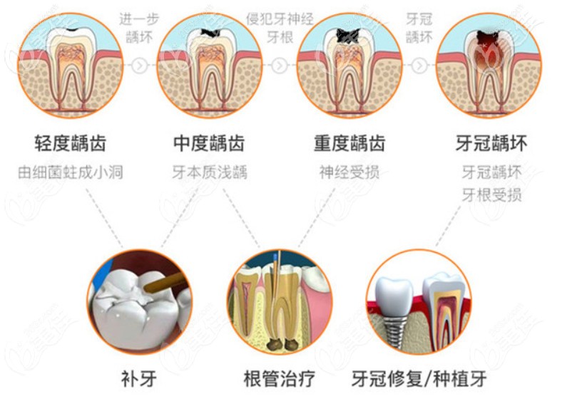 根据龋齿情况进行补牙根管治疗和戴牙冠