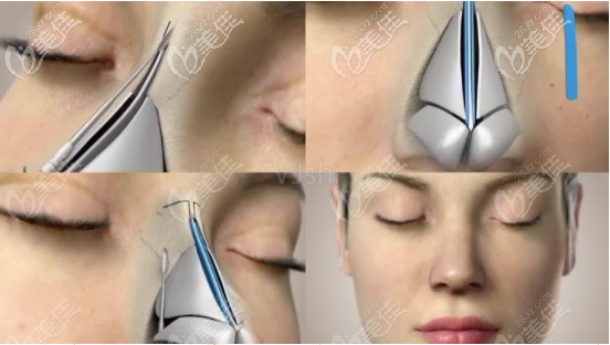 张浩短期内可开展鼻修复手术