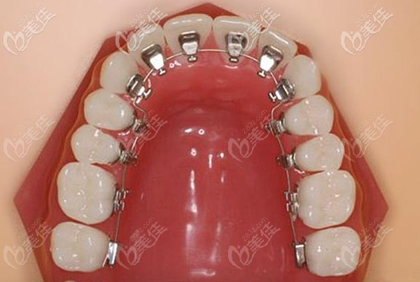 舌侧隐形矫正的优势