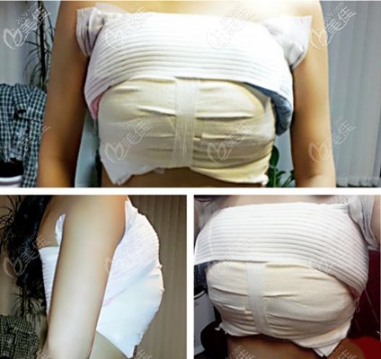 假体隆胸后包扎图片